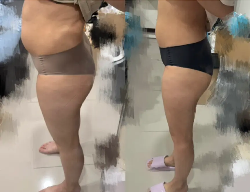 S 小姐腰腹前後對比